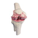 Erler-Zimmer Knie-Implantat-Modell, 3 Teile