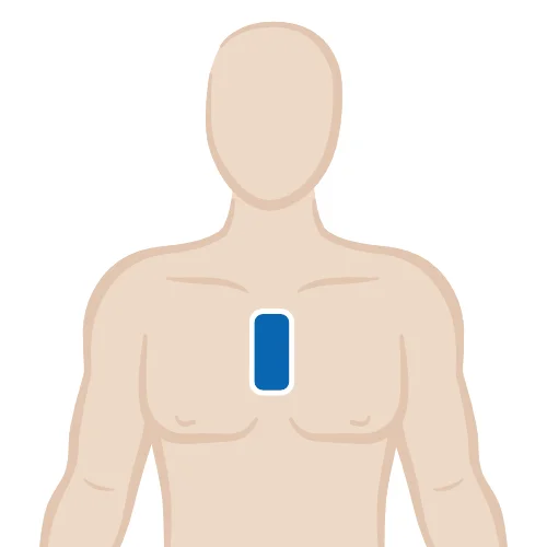 EKG-Elektroden-kleben_1-Kanal-EKG.webp