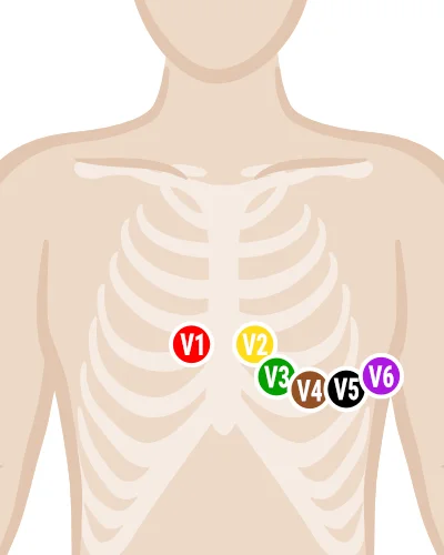 EKG-Elektroden-kleben_12-Kanal-EKG.webp