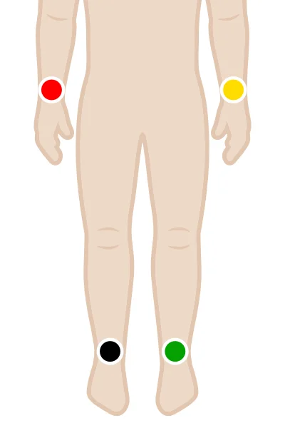 EKG-Elektroden-kleben_3-Kanal-EKG.webp