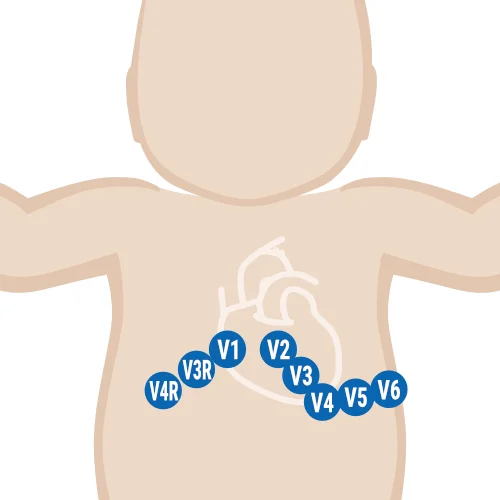 EKG-Elektroden-kleben_Brustwandelektroden-Kleinkinder.webp