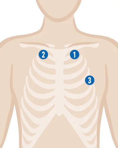 EKG-Elektroden-kleben_Langzeit-EKG-3-Elektroden.webp