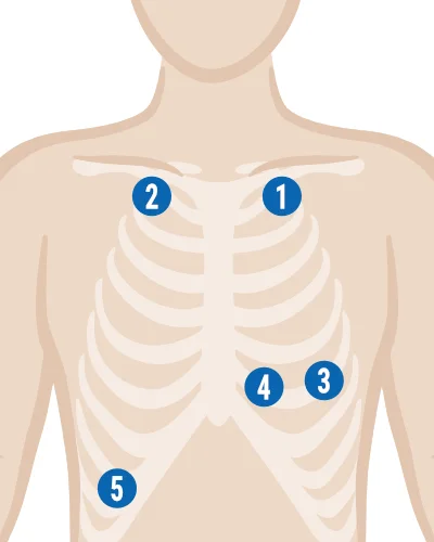 EKG-Elektroden-kleben_Langzeit-EKG-5-Elektroden.webp
