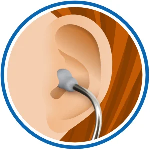 Positionierung der Ohroliven im Ohr